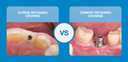 Screw-Retained vs. Cement-Retained Implant Crowns: How to Choose the Right Restoration image
