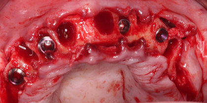 Glidewell HT Implants are placed immediately into extraction sites, establishing the stability needed for provisionalization and long-term reconstruction of both the patient’s arches. thumbnail image