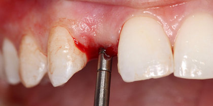 Tooth #7 is restored using a narrow-diameter Glidewell HT Implant. thumbnail image