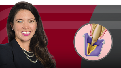 Restoring Implants: Tissue Preparation and Impression Techniques Hero Image image