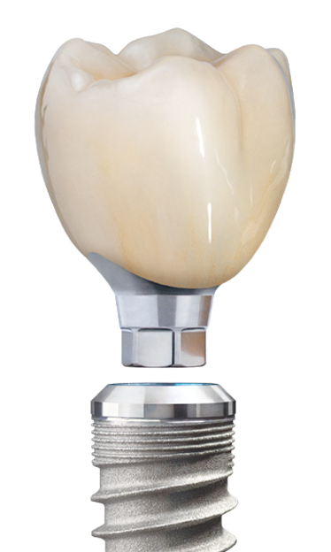 Screw-retained abutment