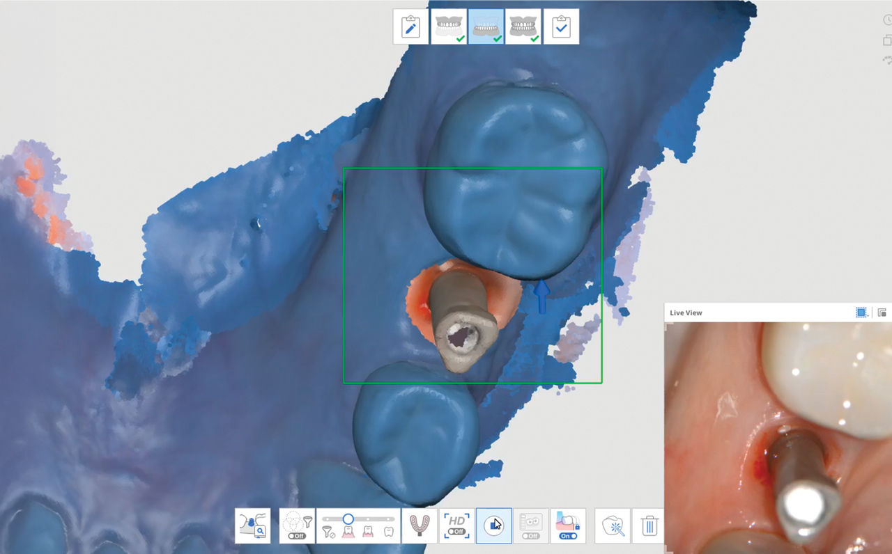 Mistake #2: Incomplete Scan Body Capture
