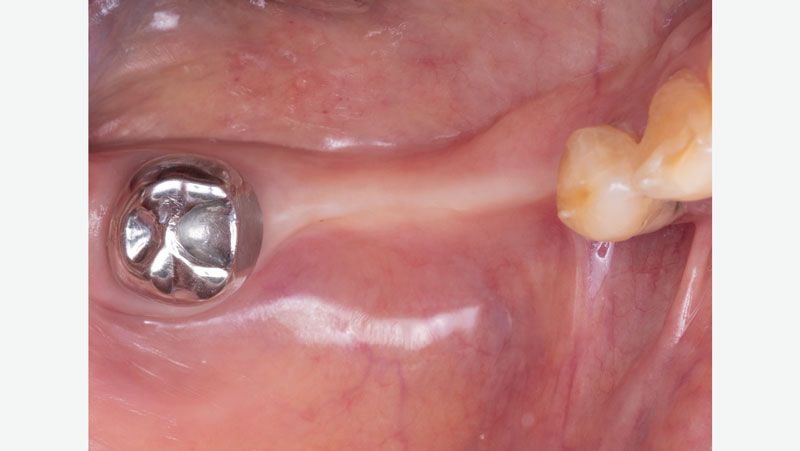 Ridge-spacing-without-partial