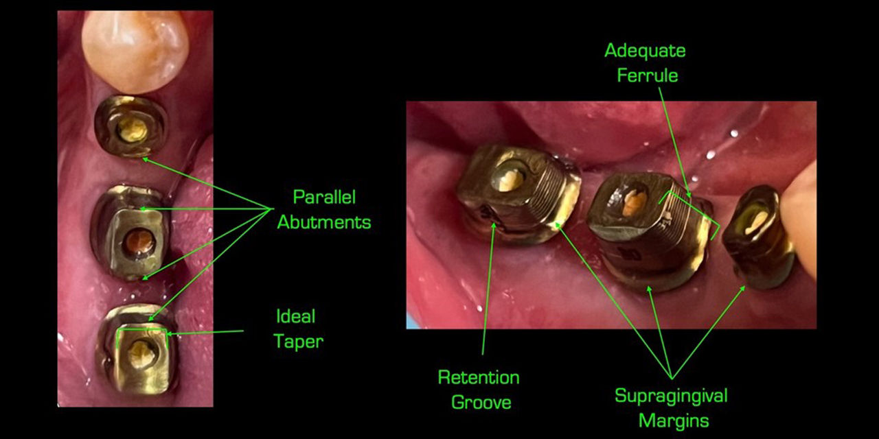 Seated custom abutments in sites 29-30-31