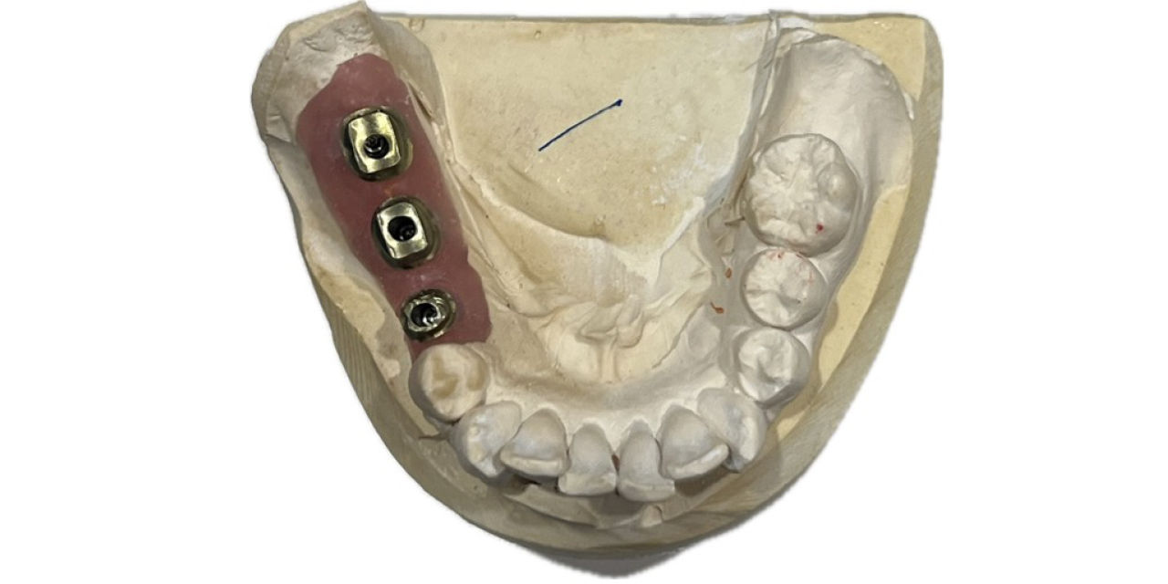 Digitally designed, parallel gold-anodized custom abutments with supragingival margins