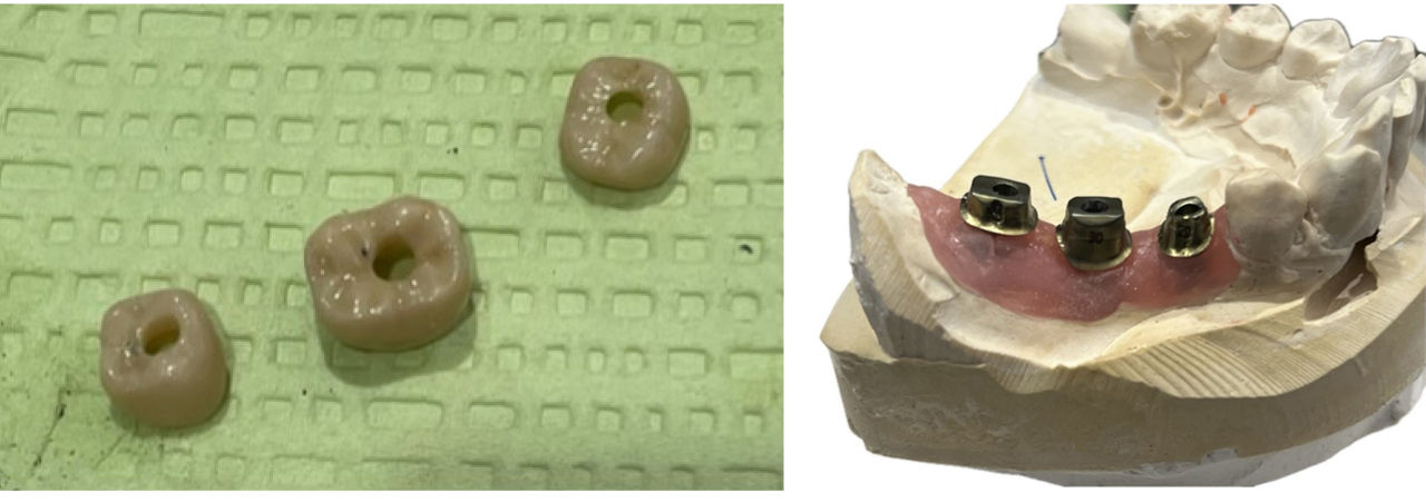 Extraoral-cementation-of-individual-crowns-to-gold-anodized-custom-abutments