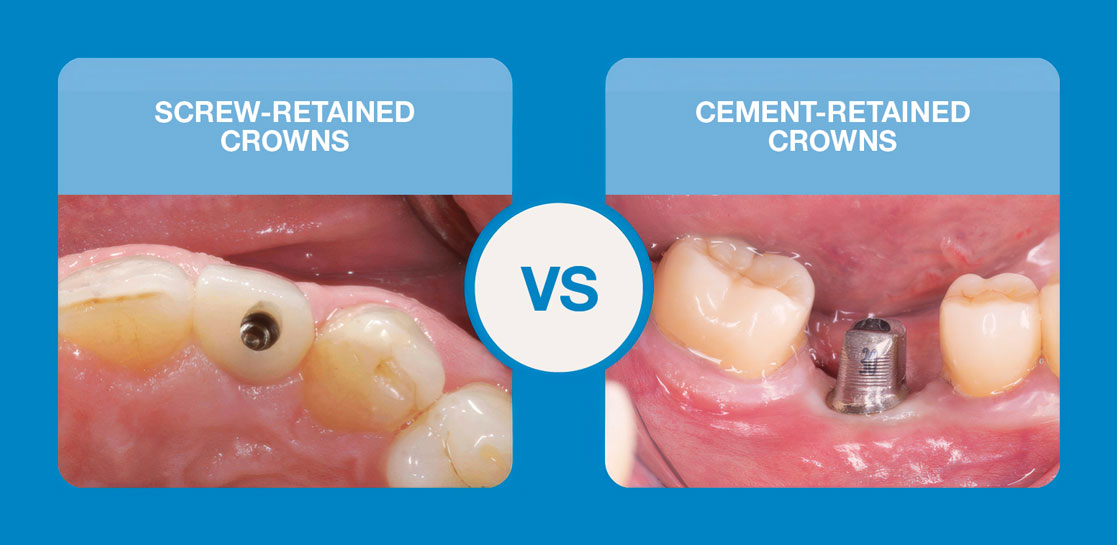 Screw-Retained vs. Cement-Retained Implant Crowns: How to Choose the Right Restoration