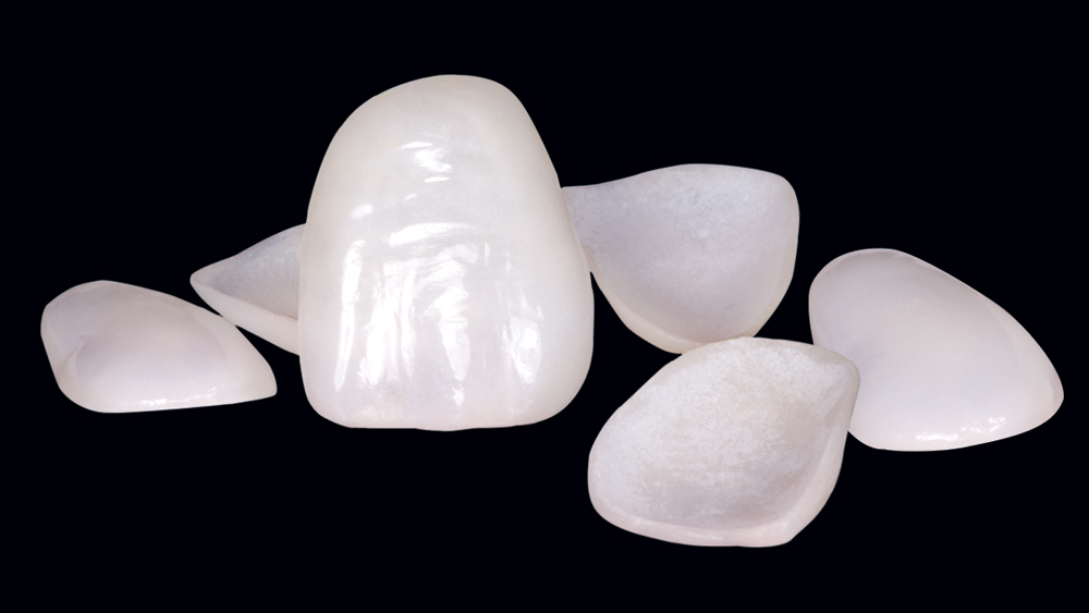 Image of veneers