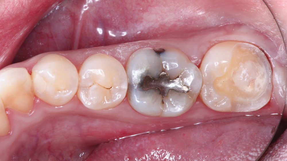 Patient's tooth #31 during prep of onlay