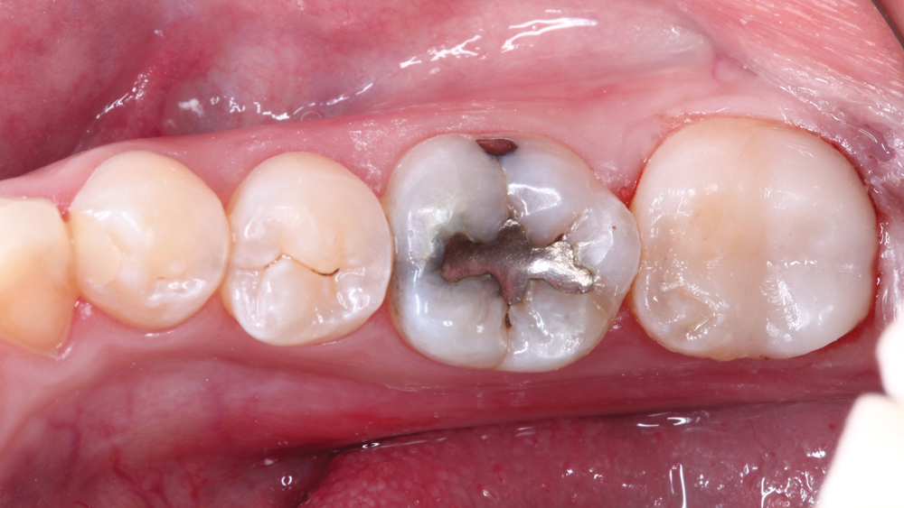 Patient's tooth #31 after onlay was delivered