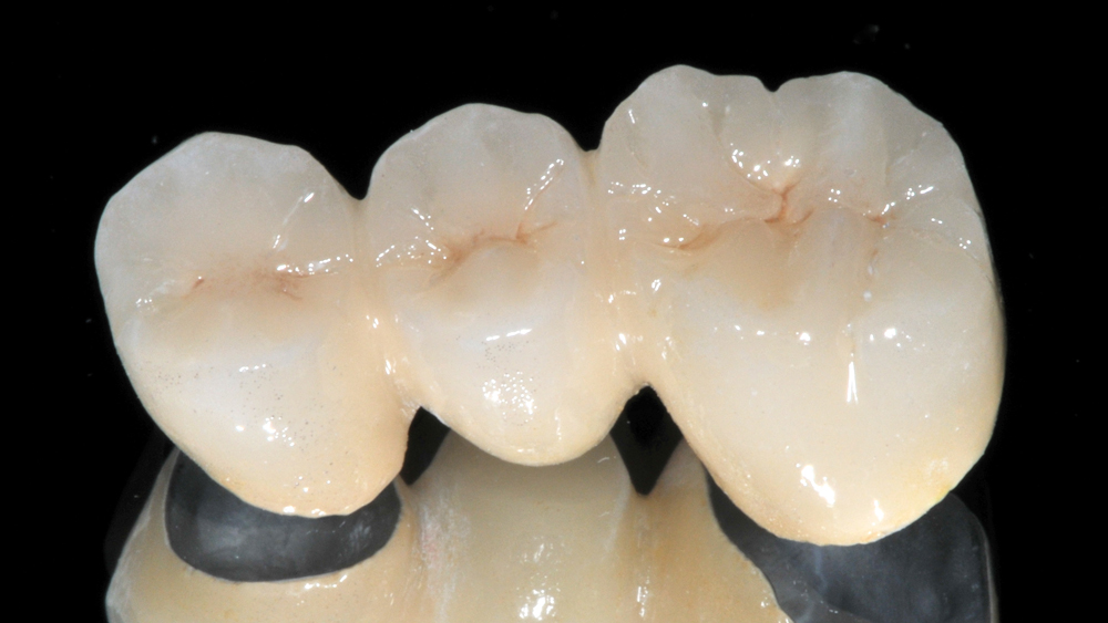 3-unit bridge Obsidian Fused to Metal