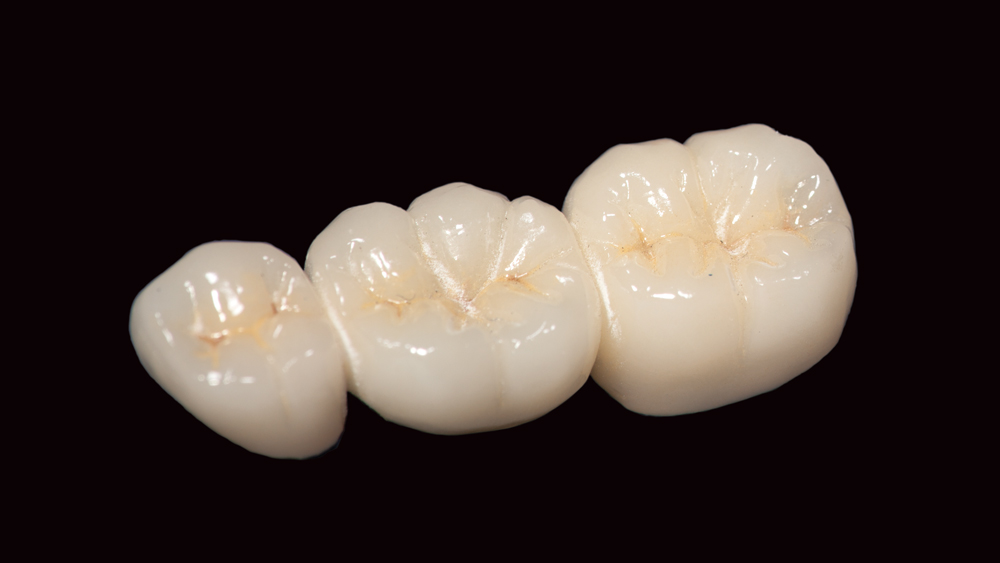 Traditional PFM restoration