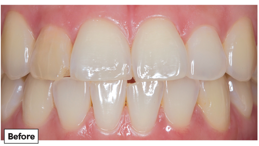 Before patient teeth photo of Obsidian Fused to Metal restoration on tooth #7