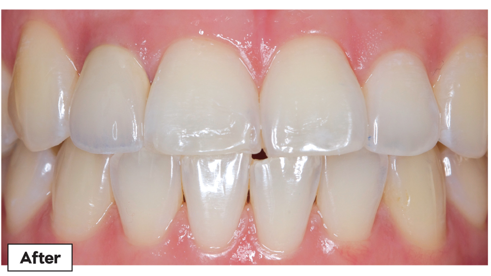 After patient teeth photo of Obsidian Fused to Metal restoration on tooth #7