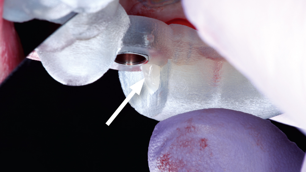 The window of the surgical guide (11c), which is incorporated in the design to ease verification of full seating of the guide against the teeth