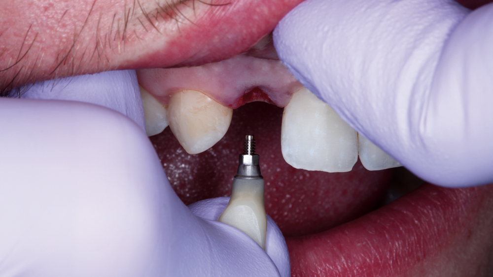 BioTemps screw-retained crown was delivered using a hand driver