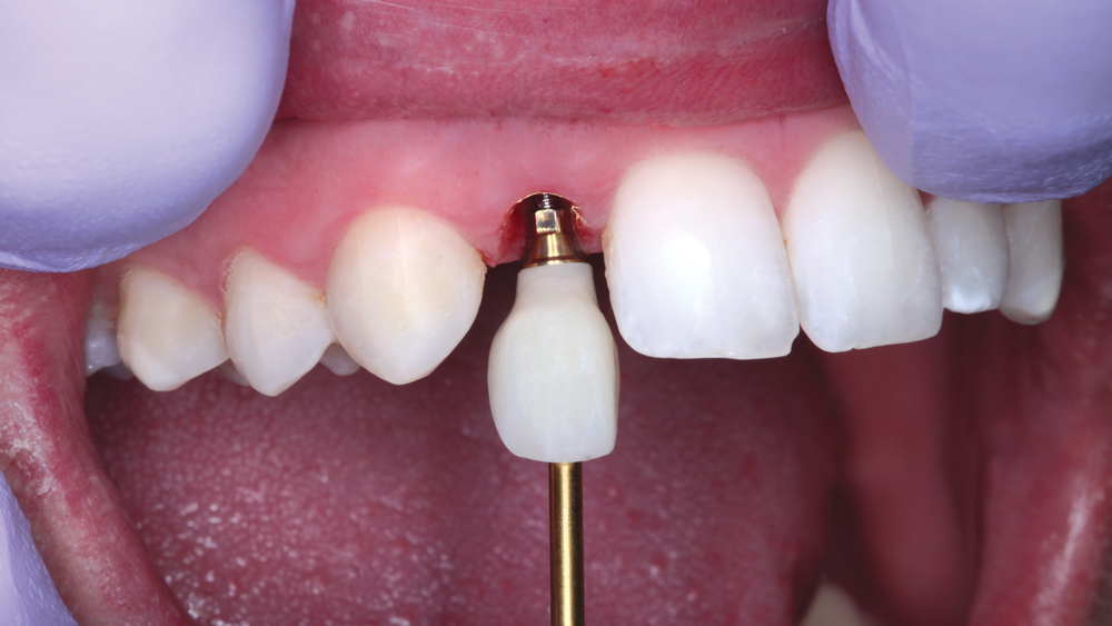 final BruxZir Anterior crown is delivered