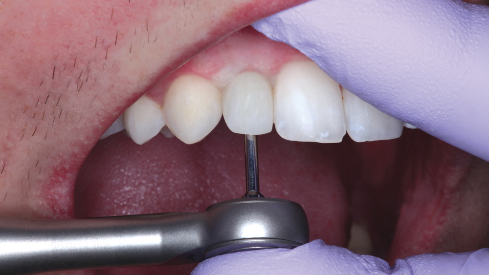 final BruxZir Anterior crown is delivered that did not require any chairside adjustments