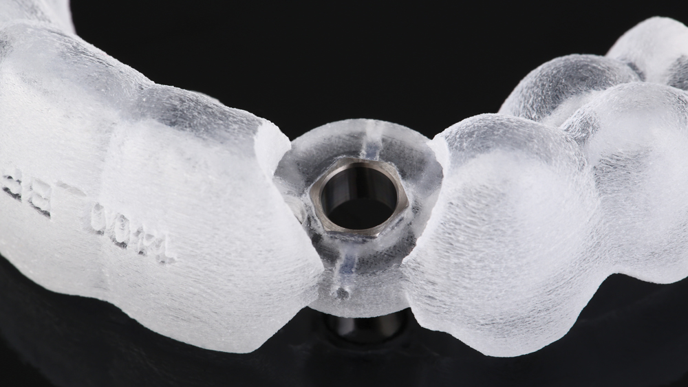 Close-up of titanium sleeve secured within the surgical guide