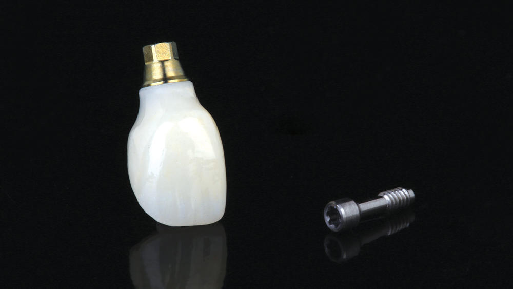 The final screw-retained crown was fabricated from BruxZir® Anterior Solid Zirconia