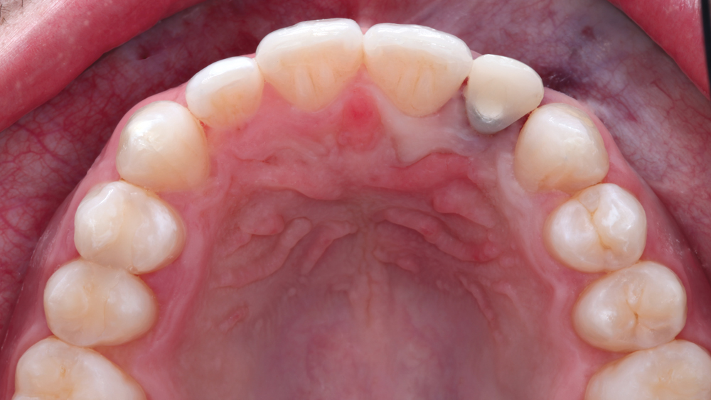 Occlusion of the BioTemps provisional