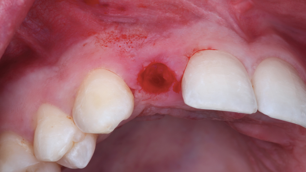Image of tooth extracted