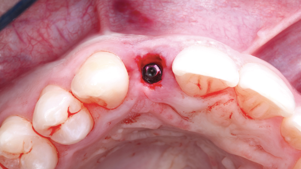 Postoperative view of implant in exact position by the digital treatment plan