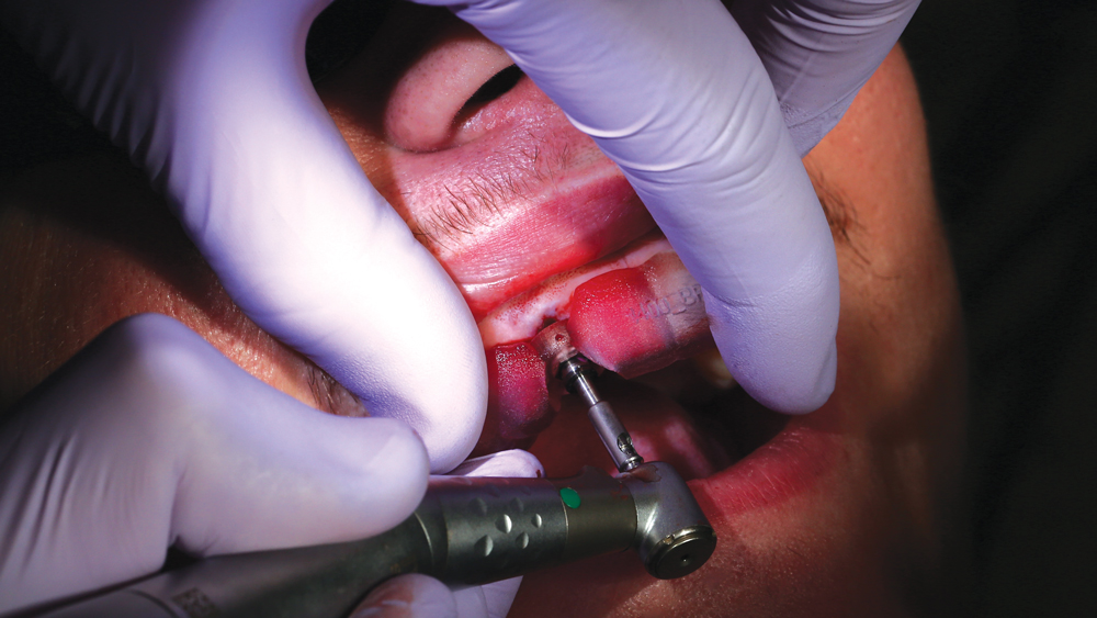 Image of shaping drills utilized to establish the precise diameter and length of the prescribed 3.5 mm x 13 mm Hahn Tapered Implant