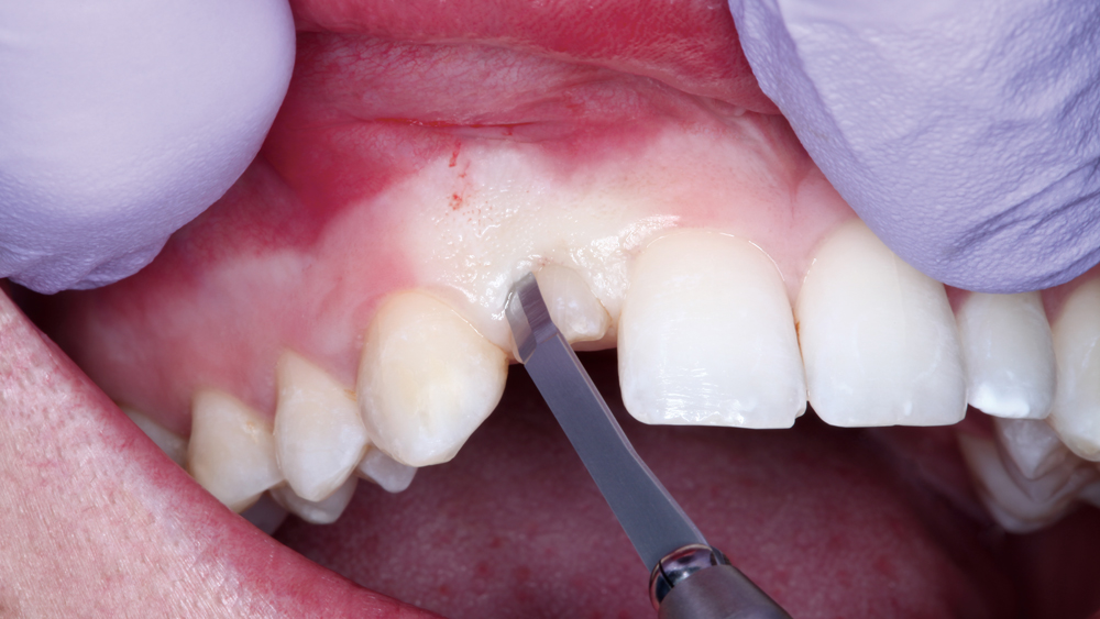 Image of tracing the circumference of the crown with a microblade