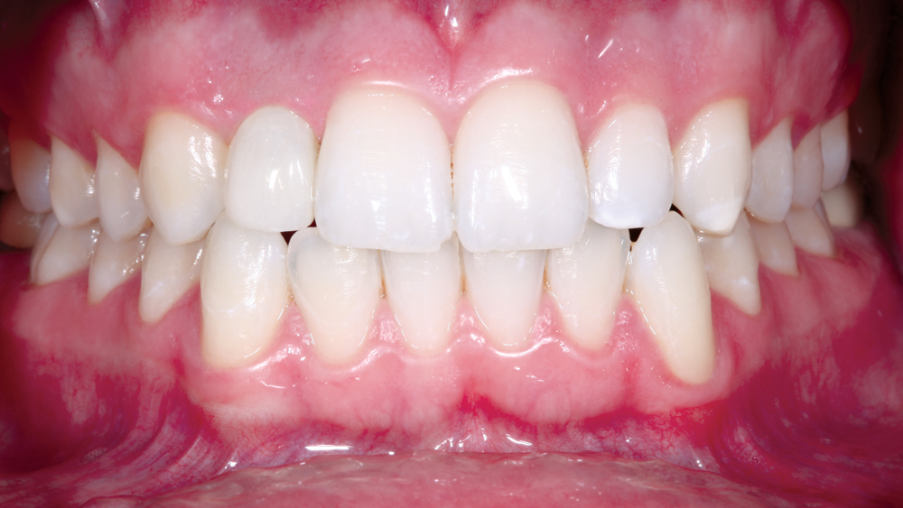 Patient's front view with the final restoration