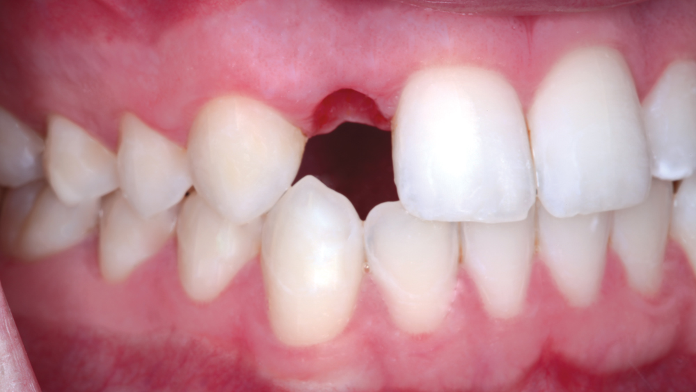 Final delivery appointment, temporary crown is removed