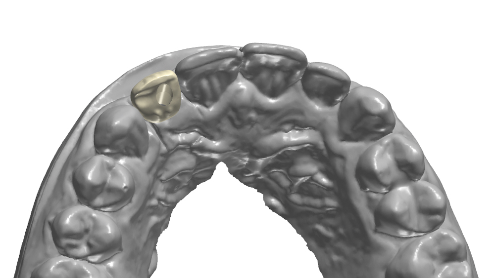Dental CAD software of final crown design 