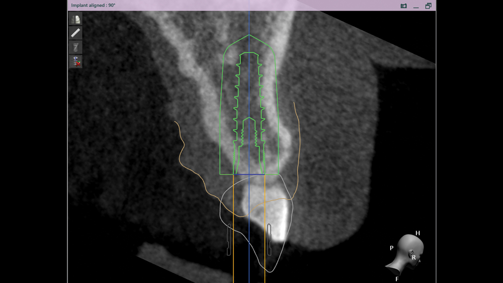 DTP team proposes digital treatment plan through CBCT scans