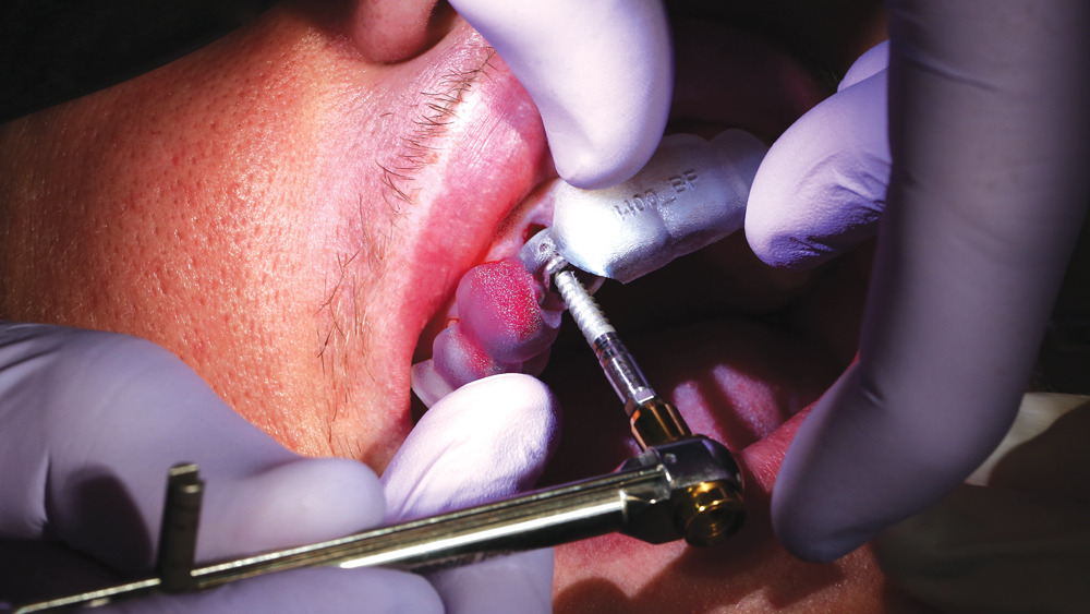 Implant is placed directing through the guide with a torque wrench