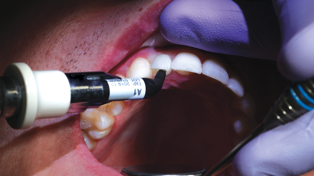 Camouflage® NanoHybrid Composite used to seal screw-access channel of the crown