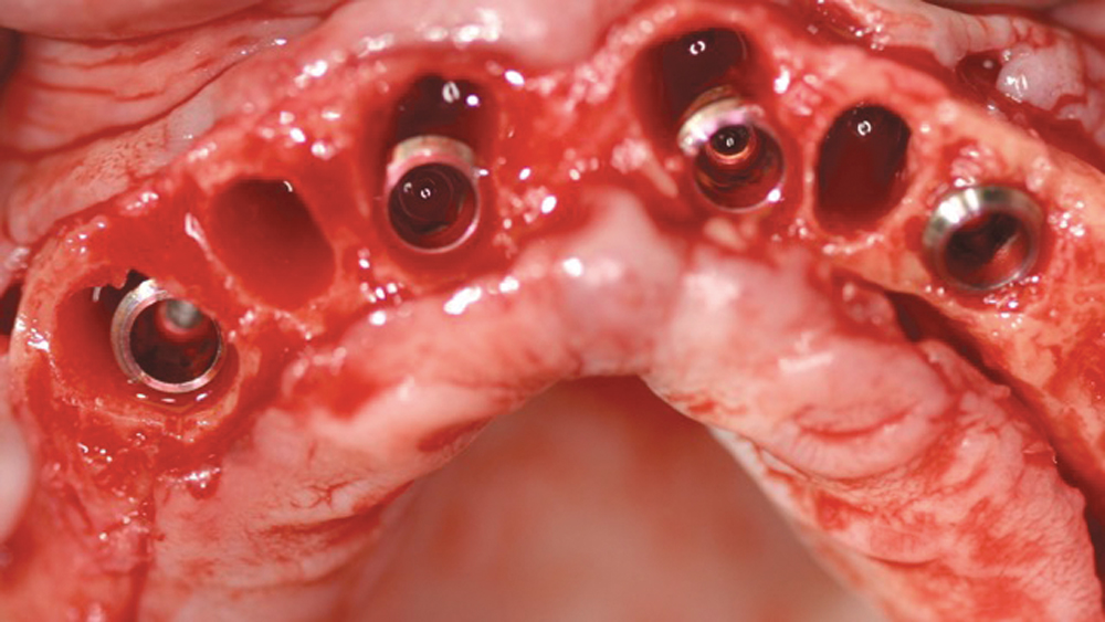 implants were inserted into the extraction sockets, their sharp, angled threads firmly engaged the palatal wall, preventing the implants from drifting toward the facial