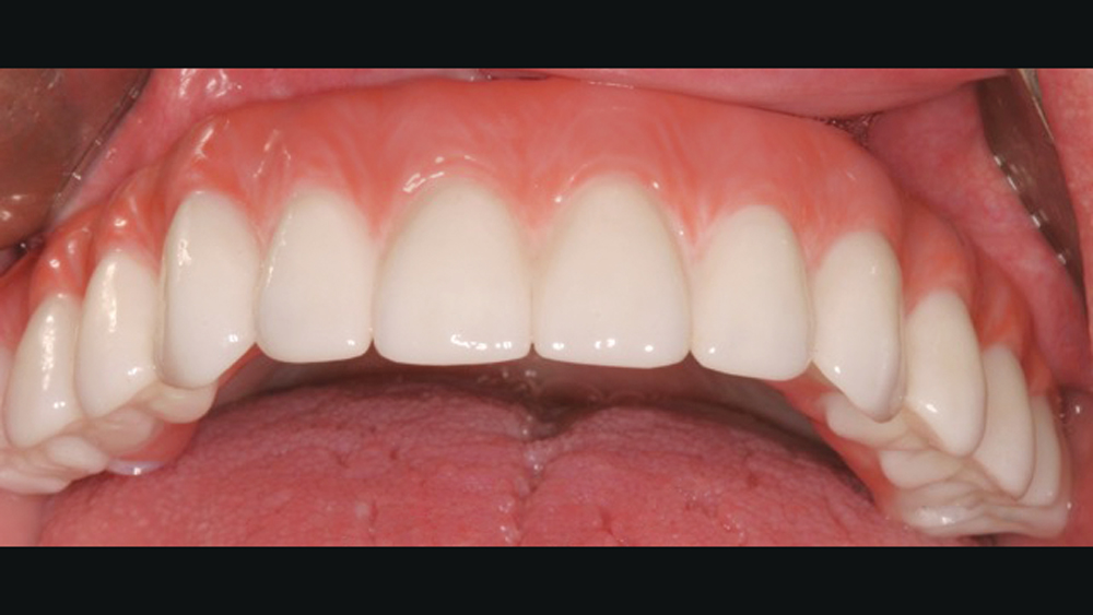 Each BruxZir Full-Arch Implant Prosthesis was tried in and established an accurate, passive fit upon seating. The prosthetic screws were then tightened, and the screw-access channels were sealed with Camouflage® NanoHybrid Composite