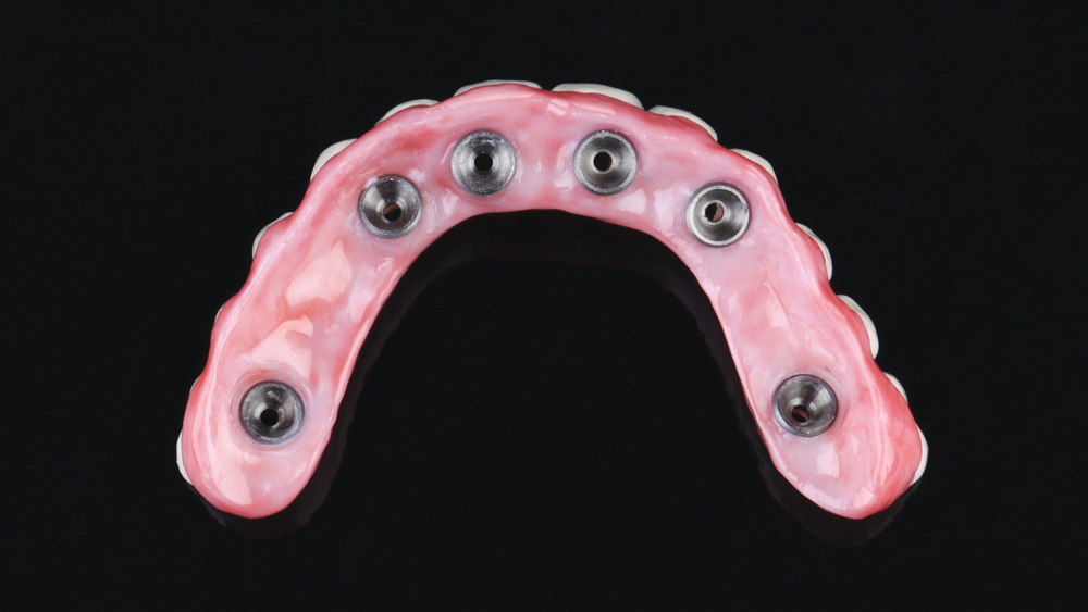 Inclusive Multi-Unit Abutments 