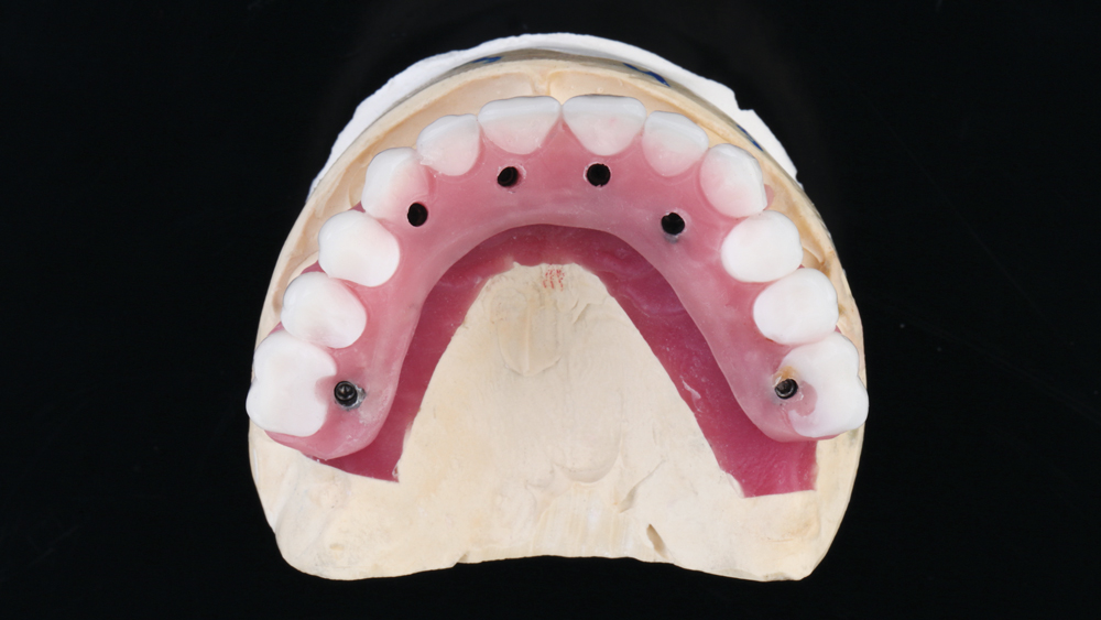 Wax rim and setup are produced by the lab