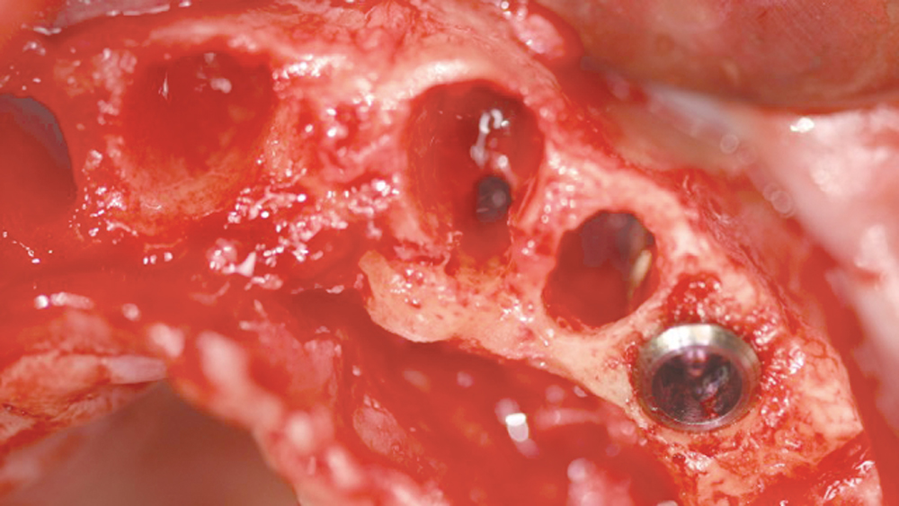 Atraumatic extraction of the patient's upper teeth of six osteotomies created