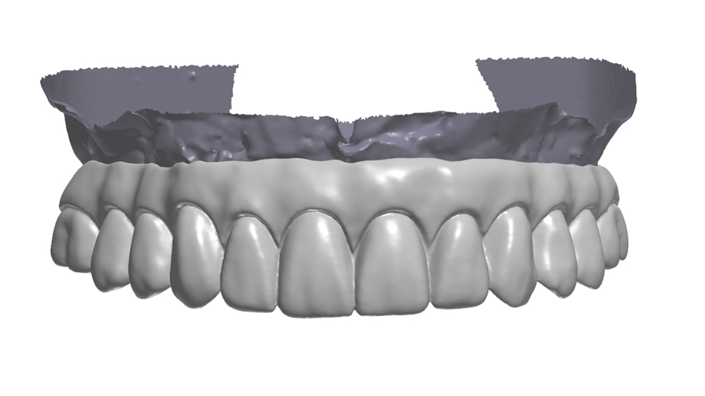 figure 8a: Scan from CAD software to create the digital design for the BruxZir restoration