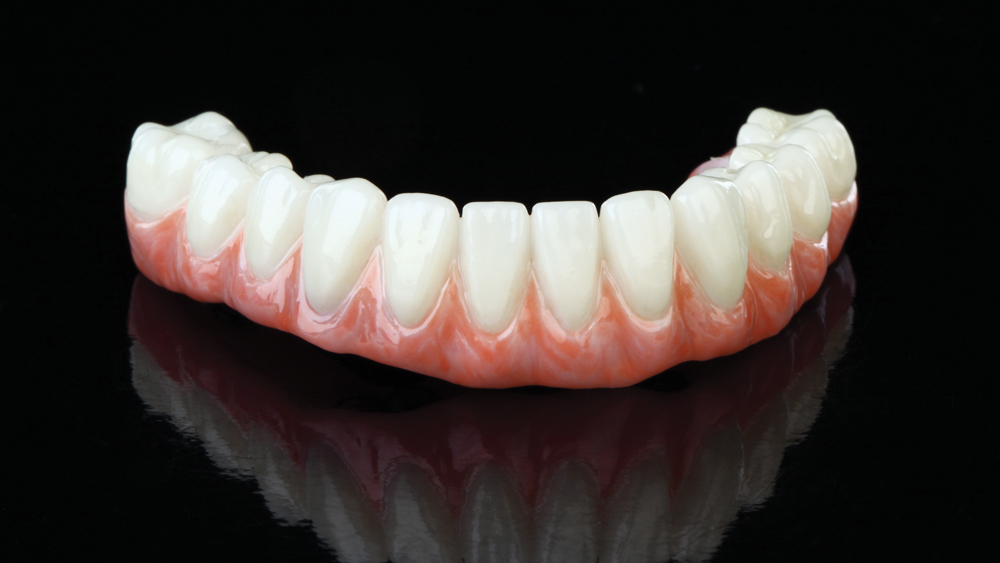 BruxZir Full-Arch Implant Prosthesis