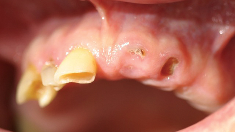 The patient sought treatment for a combination of missing teeth and dentition compromised by severe decay and fractures