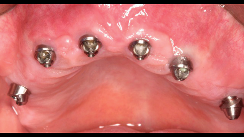 Inclusive Multi-Unit Abutments to level restorative platform on patient