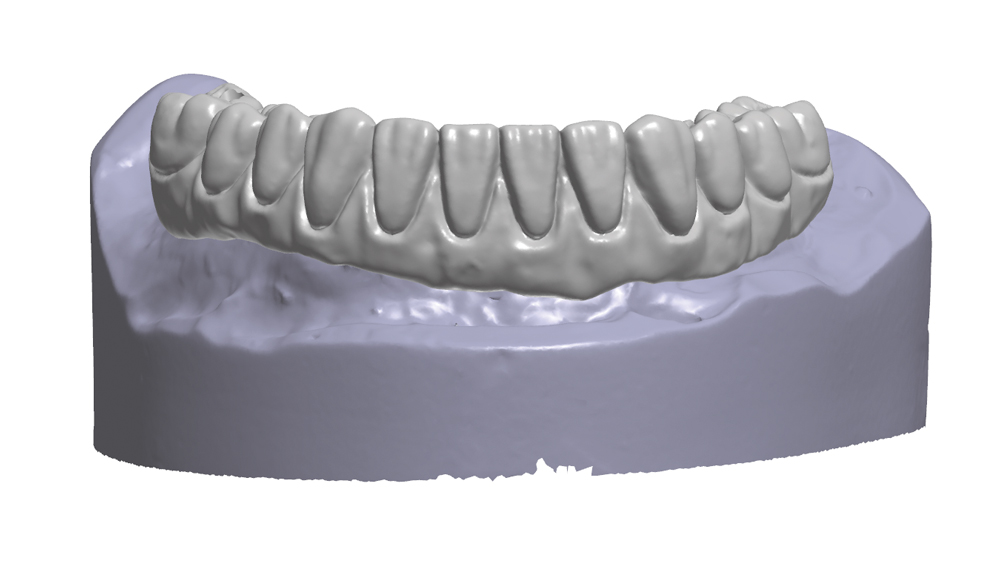 figure 8b: Scan from CAD software to create the digital design for the BruxZir restoration