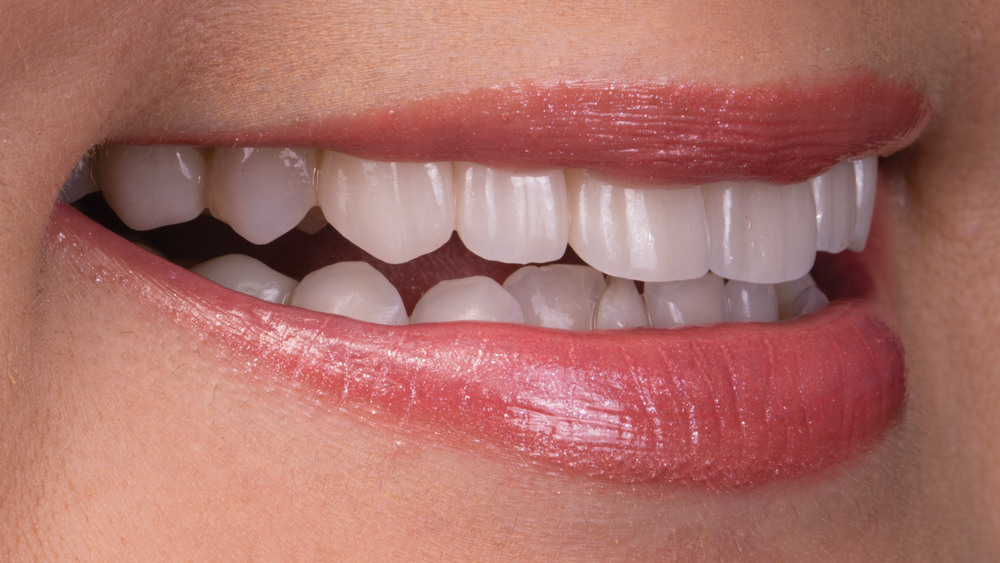 Patient's smile vertical right view