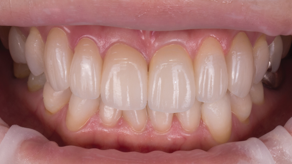 Patient with an Obsidian crown