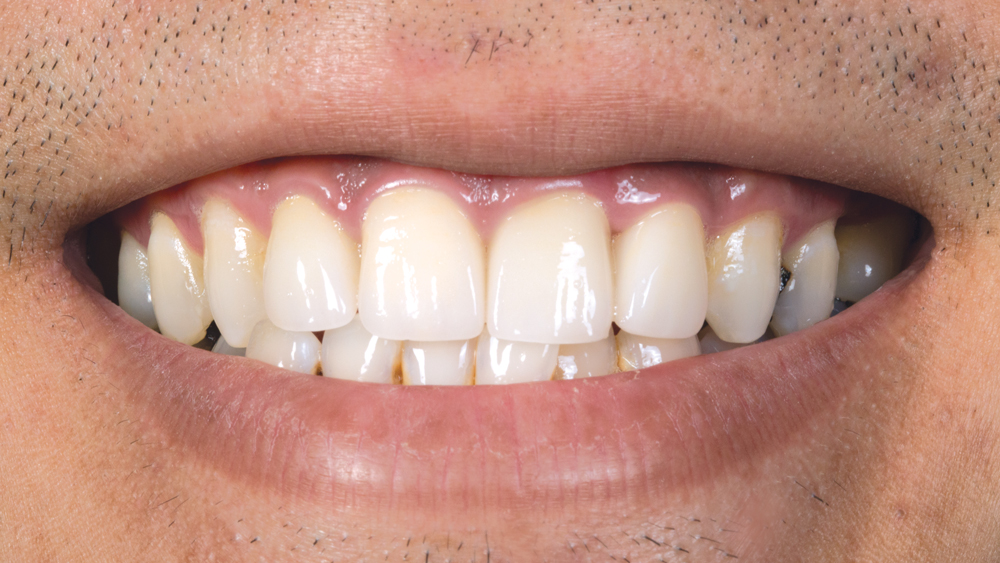 Patient restorative after photo