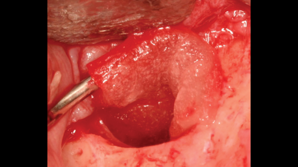 Figure 6b: hemostasis and small graft site close-up