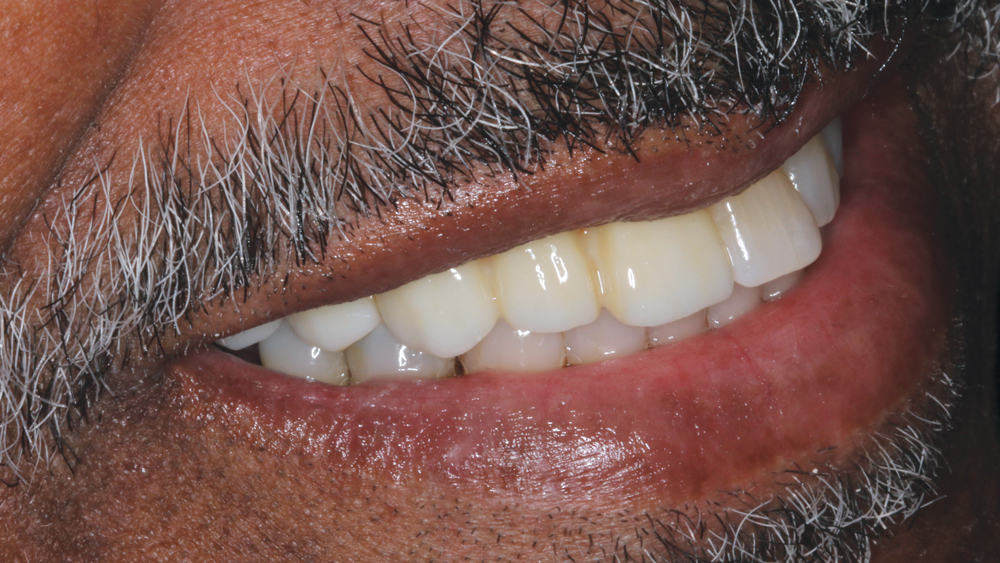 Figures 15a, 15b: The desired smile design was achieved, and the patient was thrilled with the functional and esthetic final result.